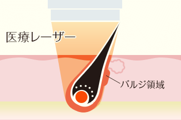 蓄熱式脱毛機