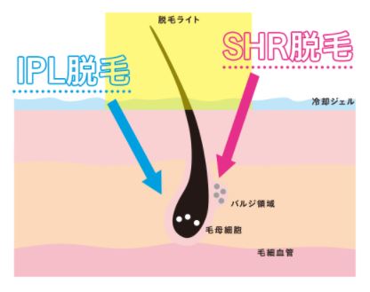 キレイモ脱毛の仕組み