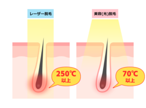 医療脱毛と美容脱毛_熱温度①